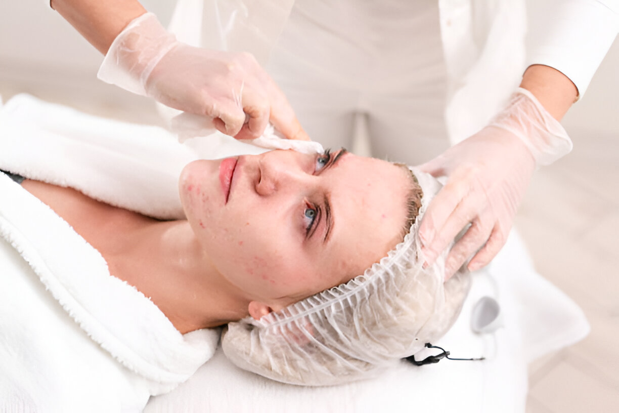 Acne scar treatment in Panchkula