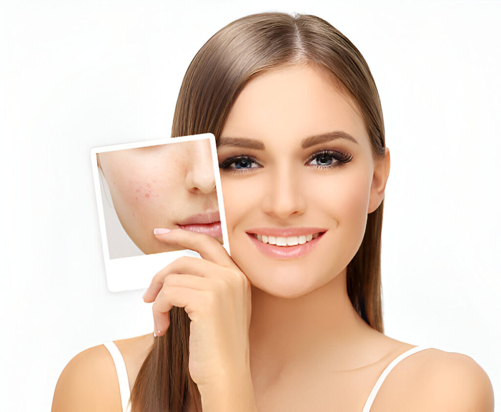 Acne scar treatment in Panchkula