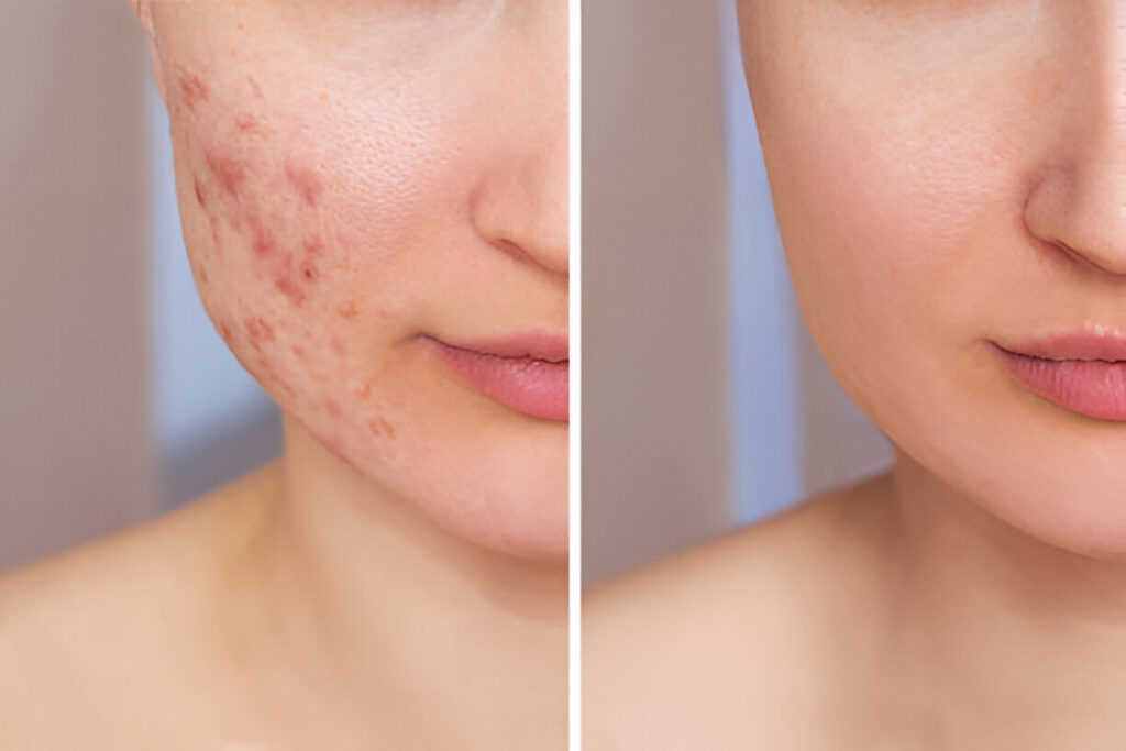 Acne scar treatment in Panchkula